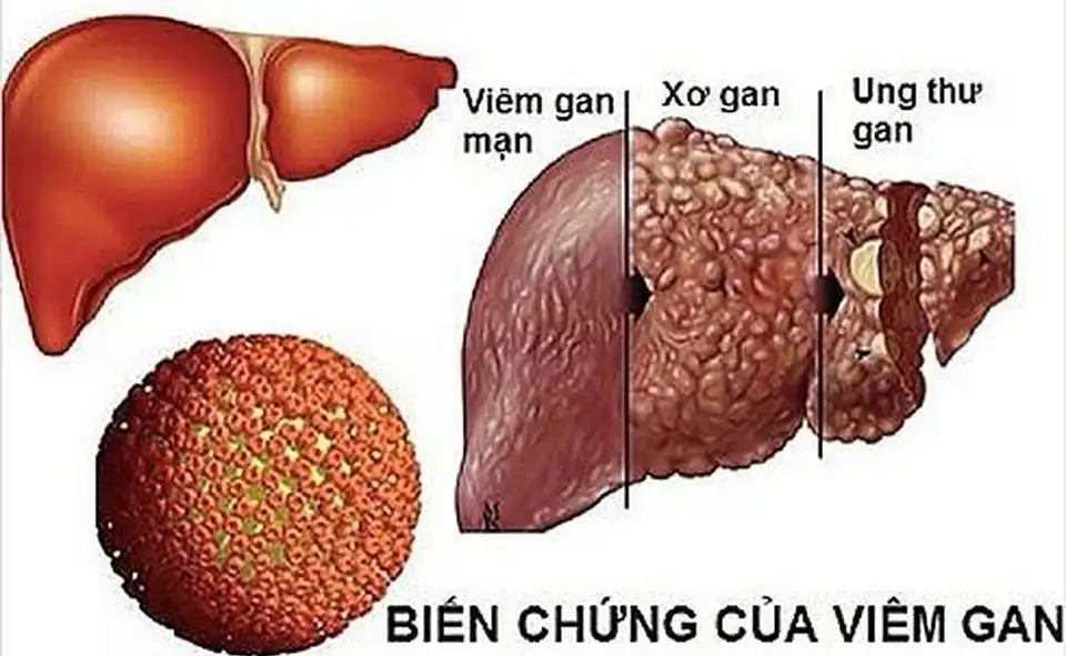 Ung thư gan: Hiểu đúng để phát hiện sớm và điều trị hiệu quả